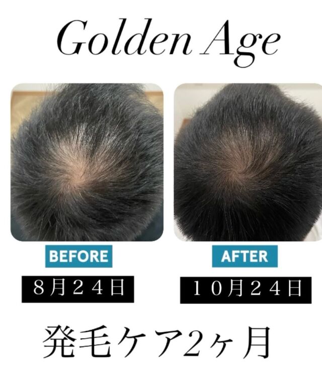 こんにちは！
Golden Age（ゴールデンエイジ）コバケン先生です！

最近こんなお悩みありませんか🤔？
・生え際、分け目が薄くなってきた

・髪の毛が細く元気がなくなってしまった

・髪の量がなくなって好きな髪型にできない

・濡れると薄毛が気になってきた

・お出掛けする時は毎日帽子で隠してる

・どこに相談していいかわからない

こちらの方は発毛ケアをされて
2ヶ月経過しているお客様になります。

・年齢は４０歳
・運動をする習慣がない
・水分を取らなかった

最初、ご来店してくれた時は食生活があまり良くなくて水分も全く取らなかったので身体を壊してしまうこともあったそうです。

毎週お店にご来店して行く内に徐々に改善されていき、今では身体を壊すこともなくなったと言ってました。

薬を使わなくて副作用もないし
むしろ健康になれるのでお客様に喜ばれています。

Golden Ageは、お薬を一切使用しないので
【お薬に抵抗がある方でも安心して改善できます】

まだ2ヶ月なので
今後の経過がとても楽しみです！

・誰にも言えずに悩んでいる方
・1人で抱え込んでいる方
・ケアしてるけど効果が出ない方

無料カウンセリングでも大丈夫なので
１度、ご来店してお話をお聞かせください！

絶対にその悩みを僕が改善させてみせます！

Golden  Ageは
【薬不使用💊🗑️】

【痛みなし💥☺️】

【副作用ゼロ❌】

【改善率98.2%📈❤️‍🩹】

【完全個室㊙️😌】

『今なら発毛ケアor育毛ケアを３３００円で体験できるのでお気軽にお問い合わせ下さい😊』

トップページ、URL又はInstagramのDMから
ご予約お待ちしております！

《発毛や育毛のスイッチにガチャリと変えていく習慣を始めましょう》

メンズ専用個室ケアサロン
【Golden Age🌹（ゴールデンエイジ）】

426-0034
静岡県藤枝市駅前1-2-1シティハウス2F
0543973510

#発毛　#育毛　#薄毛改善　#頭皮改善
#発毛藤枝　#育毛藤枝　#薄毛改善藤枝
#発毛静岡　　#薄毛改善静岡　#へッドスパ
#ヘッドスパ藤枝　#ヘッドスパ静岡
#ヘッドスパ焼津
#ハゲ #脱毛　#円形脱毛症　#AGA 
#フィナステリド　#ミノキシジル　
#静岡美容院　#藤枝美容院　#焼津美容院
#薬不使用　#完全個室　#若返り 
#藤枝　#焼津　#島田　#静岡
#牧之原市